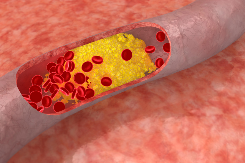 Lượng Cholesterol trong máu cao