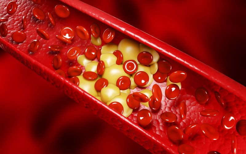 Dịch vụ lọc mỡ máu là một giải pháp hiệu quả giúp giảm mức cholesterol xấu và triglycerides
