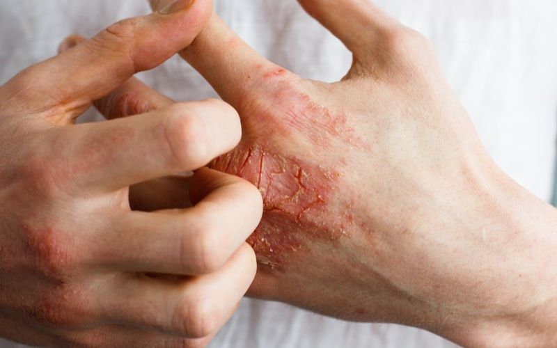 Giảm nguy cơ mắc các bệnh viêm mạn tính và các bệnh thoái hóa